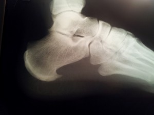 espolon footsolution