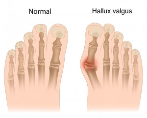 halux valgo footsolution